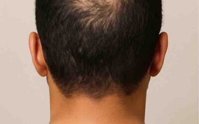 Traiter la perte de cheveux chez l’homme à Mantes-la-Jolie (78200)