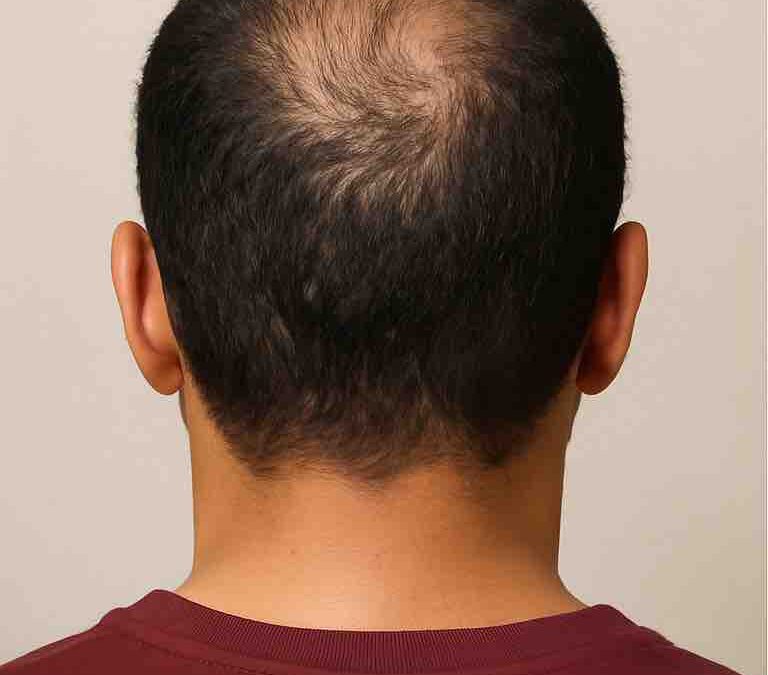 Traiter la perte de cheveux chez l’homme à Mantes-la-Jolie (78200)